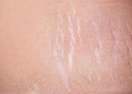 According To The Expert How To Get Rid Of Stretch Marks Permanently